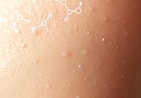 Trądzik hormonalny: przyczyny, objawy i skuteczne metody leczenia